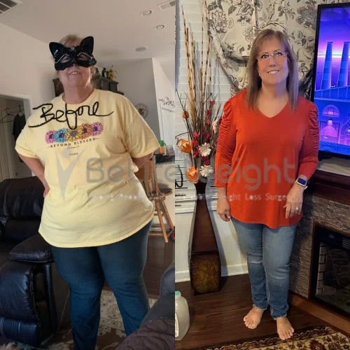 RNY Gastric Bypass Before and After Weight Loss Surgery Before and After